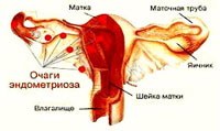 эндометриоз