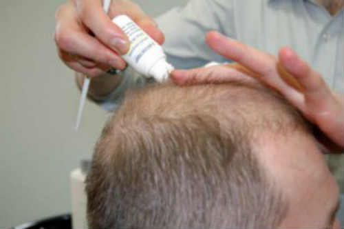 Лечение выпадения волос в домашних условиях