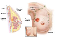 рак молочной железы