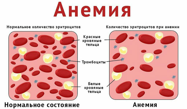 облысение при анемии