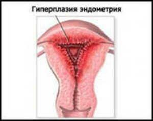 полипы гиперплазия эндометрия