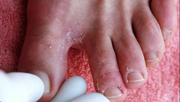 грибок на пальцах ног