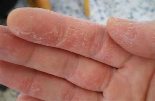 дерматит на пальцах рук