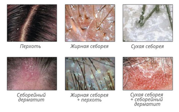 разновидности себореи, приводящие к выпадению волос