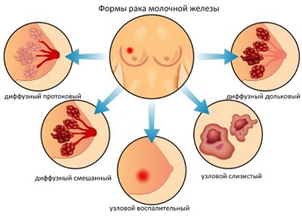 формы рака молочной железы