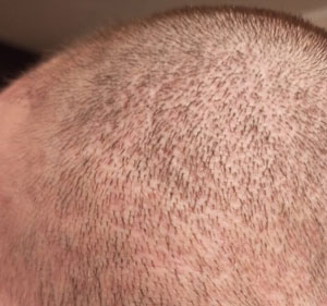 шоковое выпадение волос после пересадки