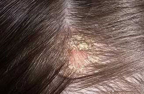 поредение волос при себорейном дерматите